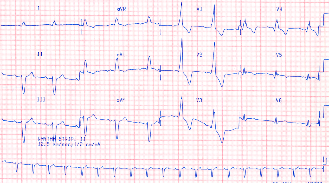 A trace taken one year previously. There is a marked LAA in different looking but definitely sinus P waves. Perhaps what is seen in Fig 145 above in lead 1 is a notched P wave without much contribution from a flat T wave? 