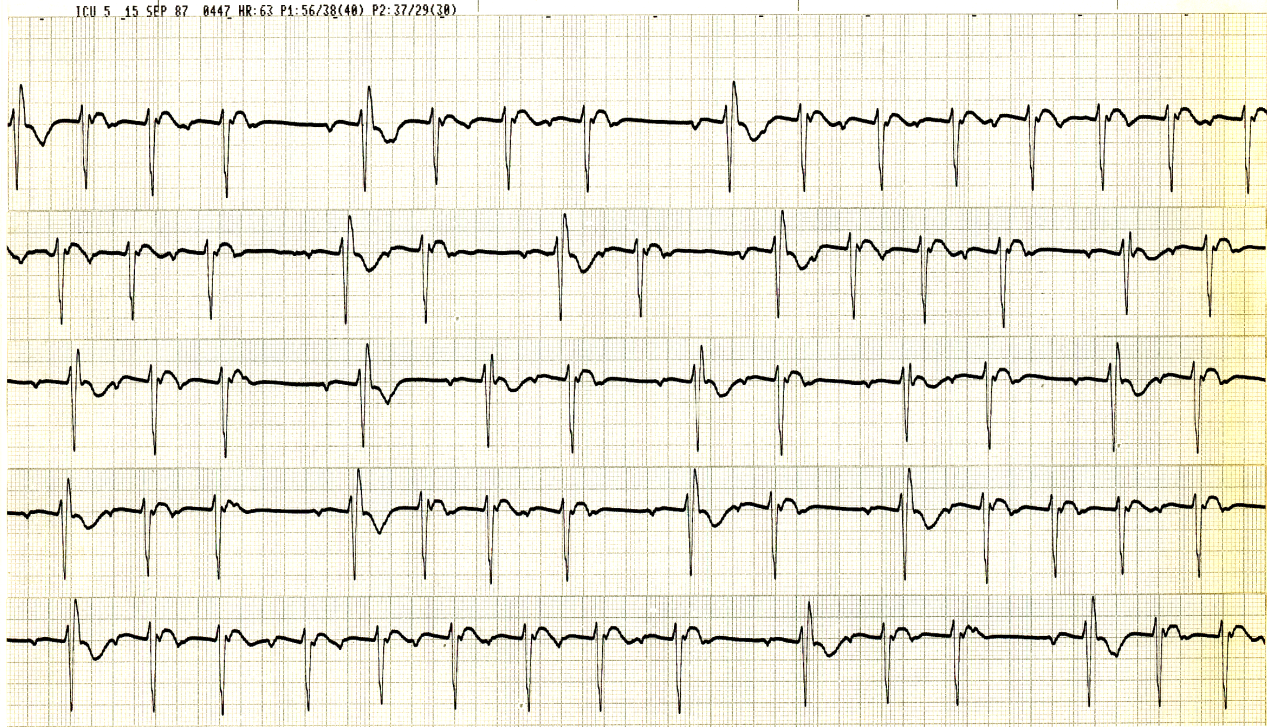 Same patient as Case 1 but with a different critical rate.