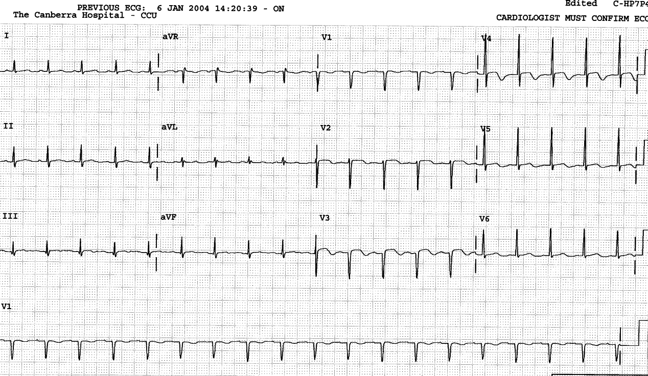 Evolving localised anterior wall infarction.