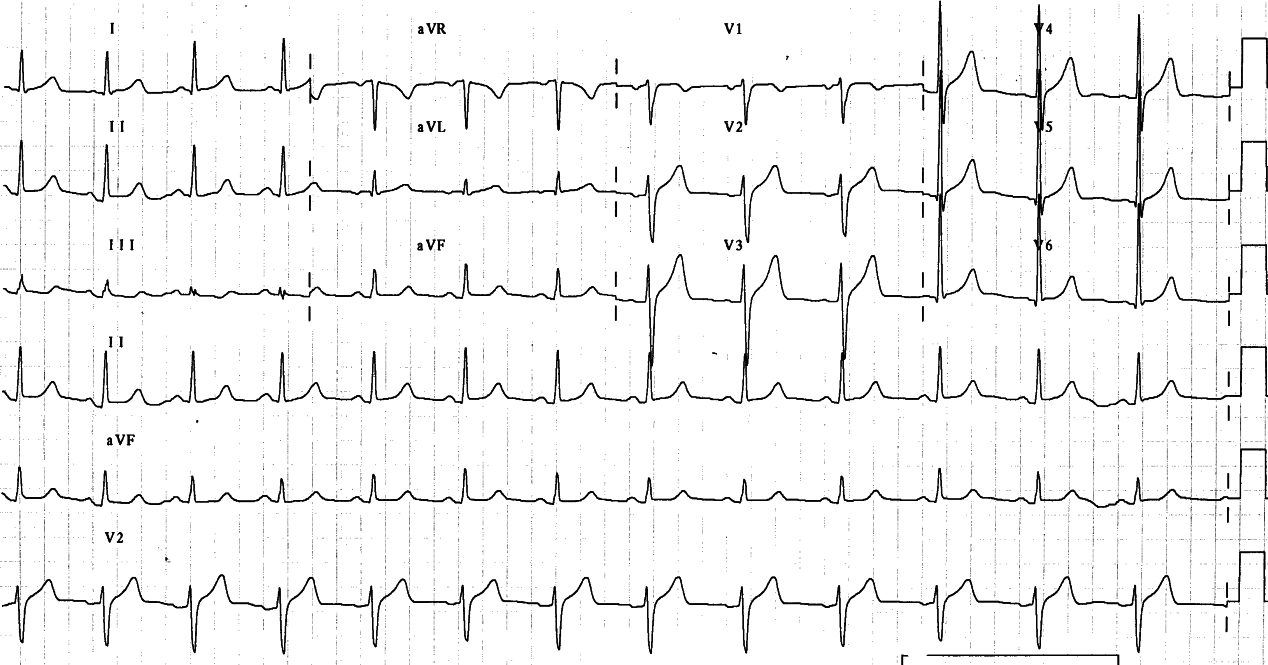 No clues for the origin of chest pain in the admission ECG. This in itself is a valid reson for admission.