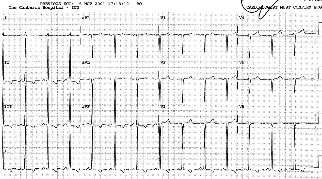 Unusual pattern of LVH with ST/T changes