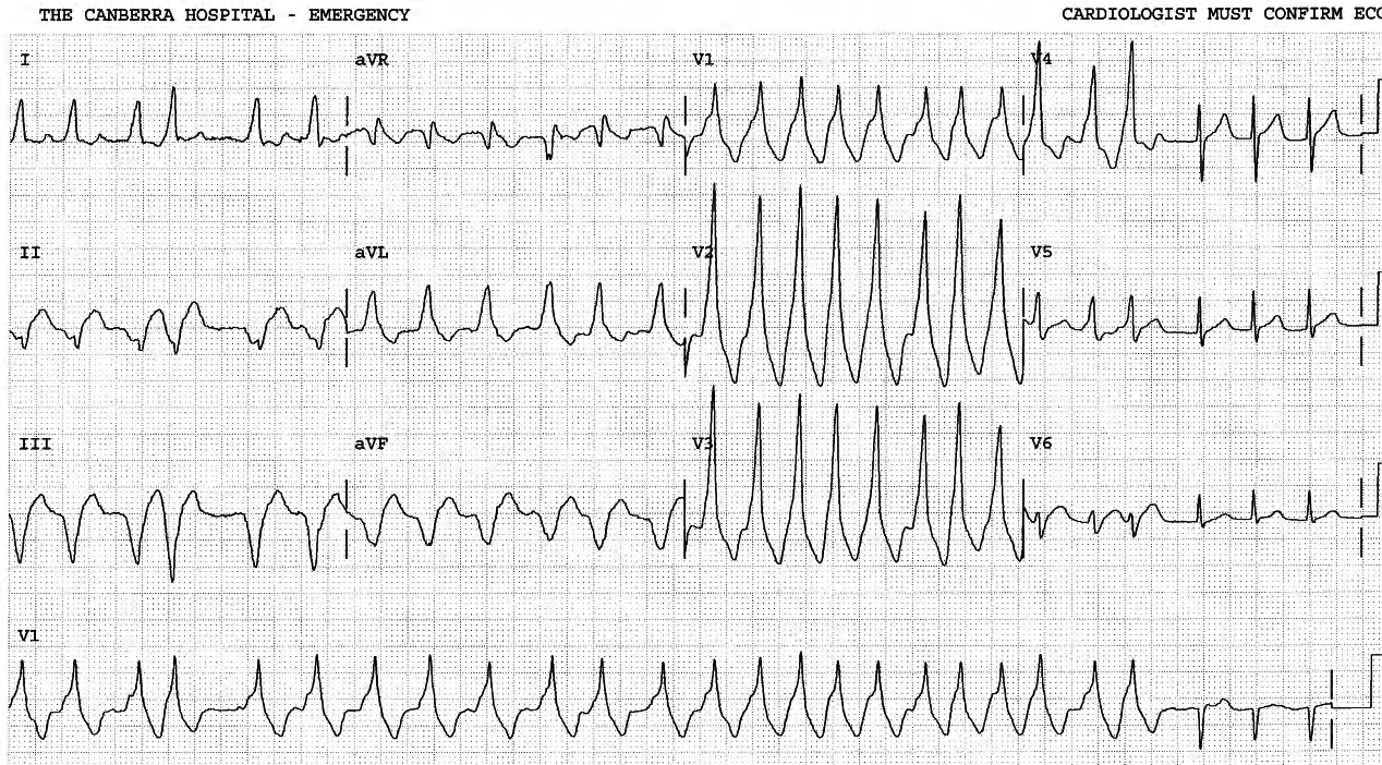 27 year old man in good general health, with palpitations for the past 14 hours. The rhythm resisted xylocaine, amiodarone and MgSO4 in Casualty. 