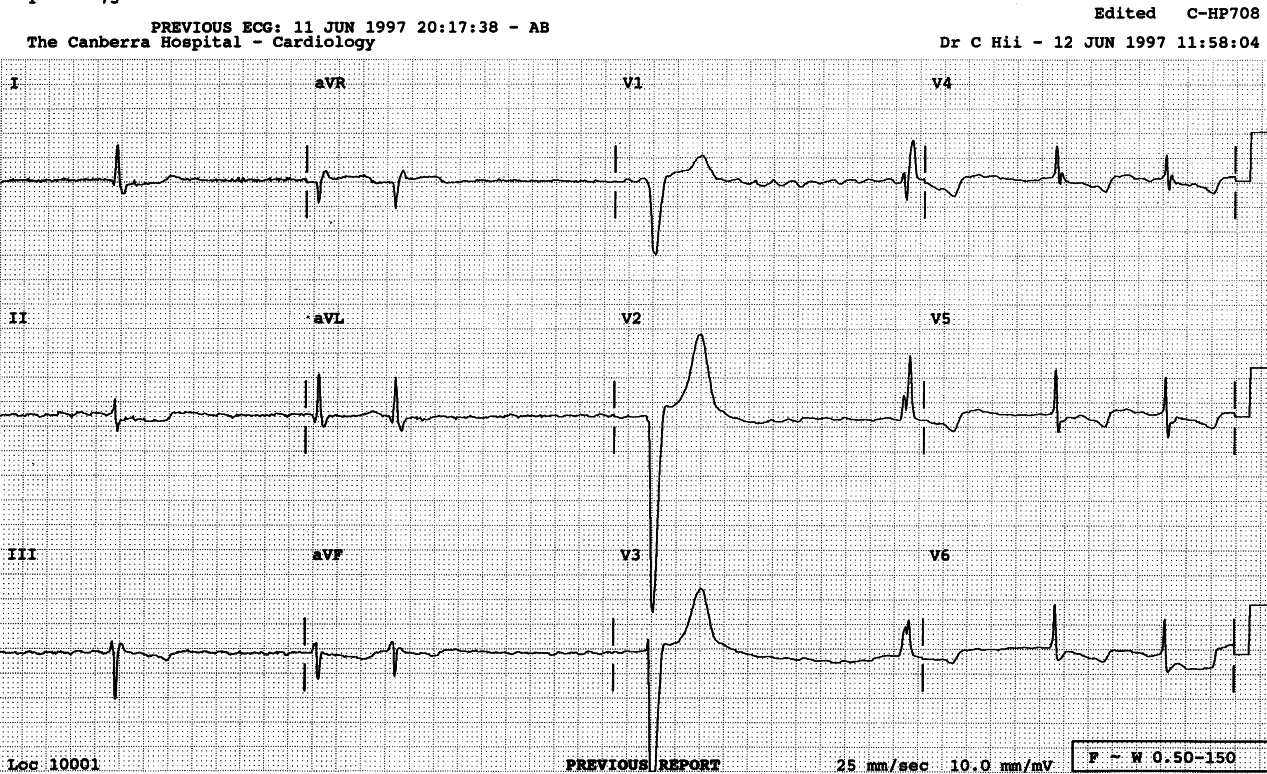 The escape VEB in the middle of the trace has the morphology of LBBB.