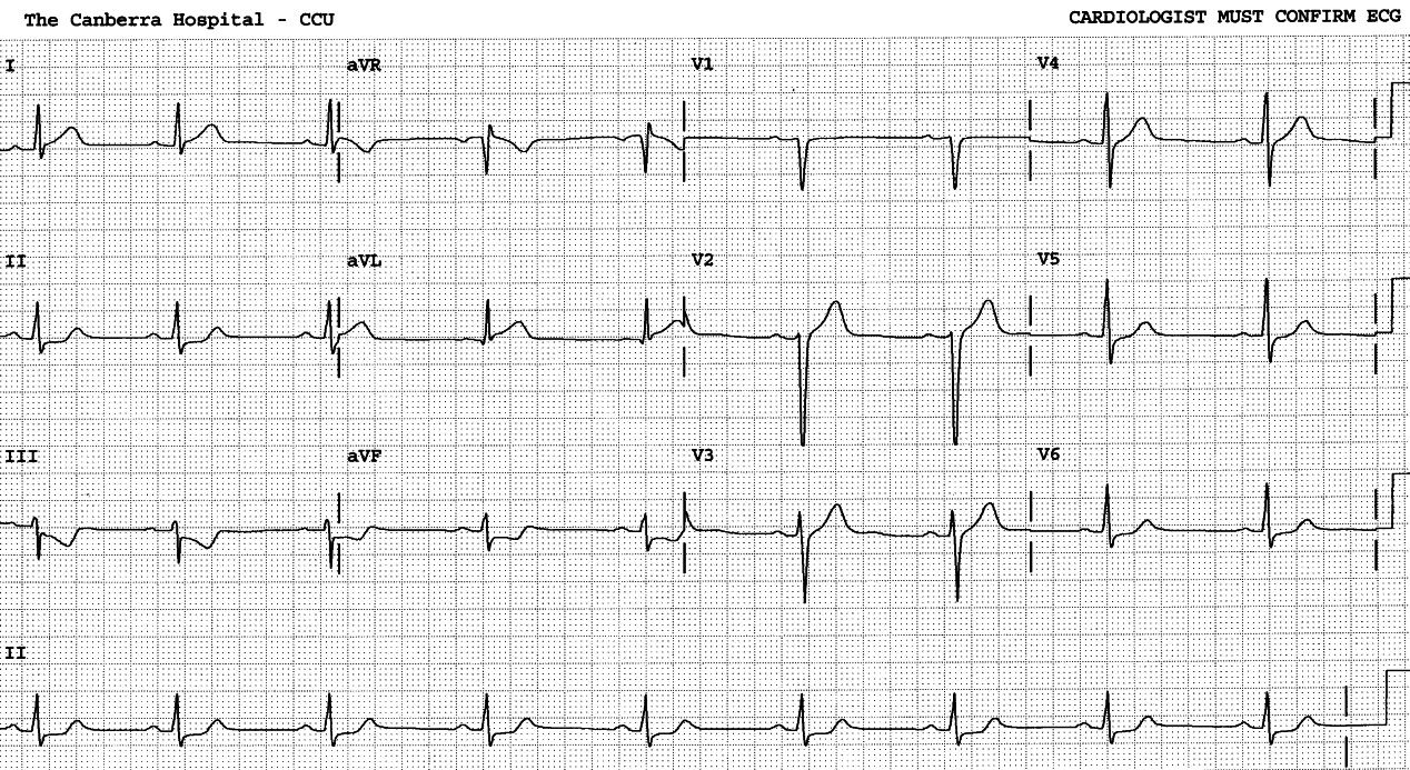 59 year old man with chest pain.