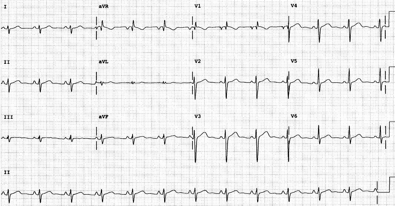 34 year old with no clinical evidence of cardiopulmonary disease. A âmental health consumerâ.