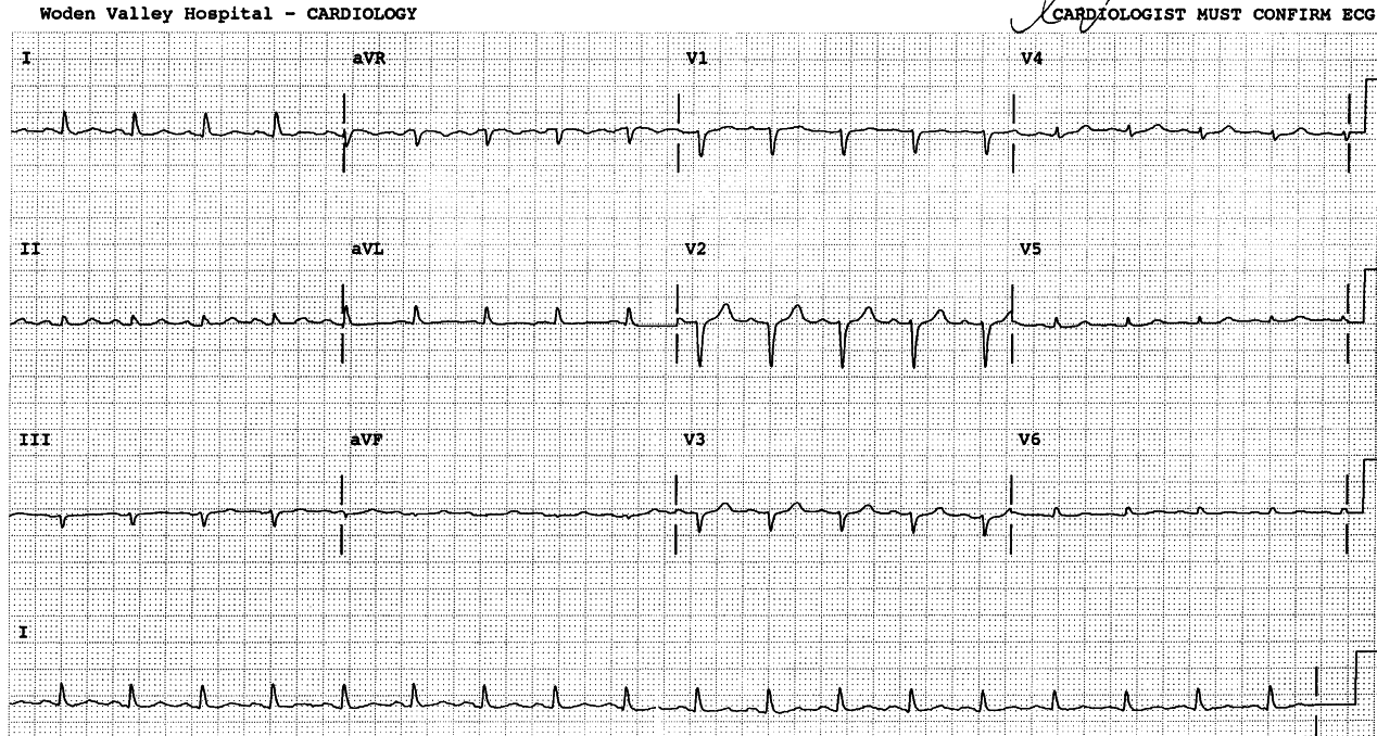 65 year old lady with ascites and peripheral Ådema