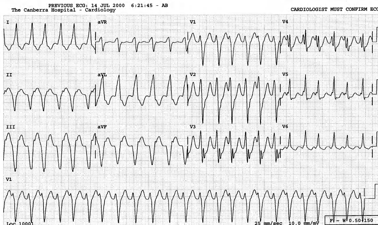 59 year old man with history of (remote) myocardial infarction and recurrent palpitations over the past several days. 