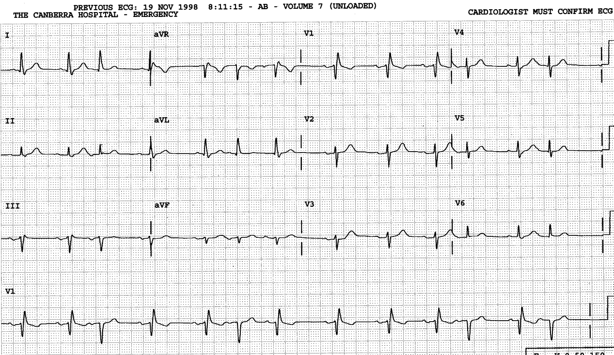 76 year old man with no known heart disease.