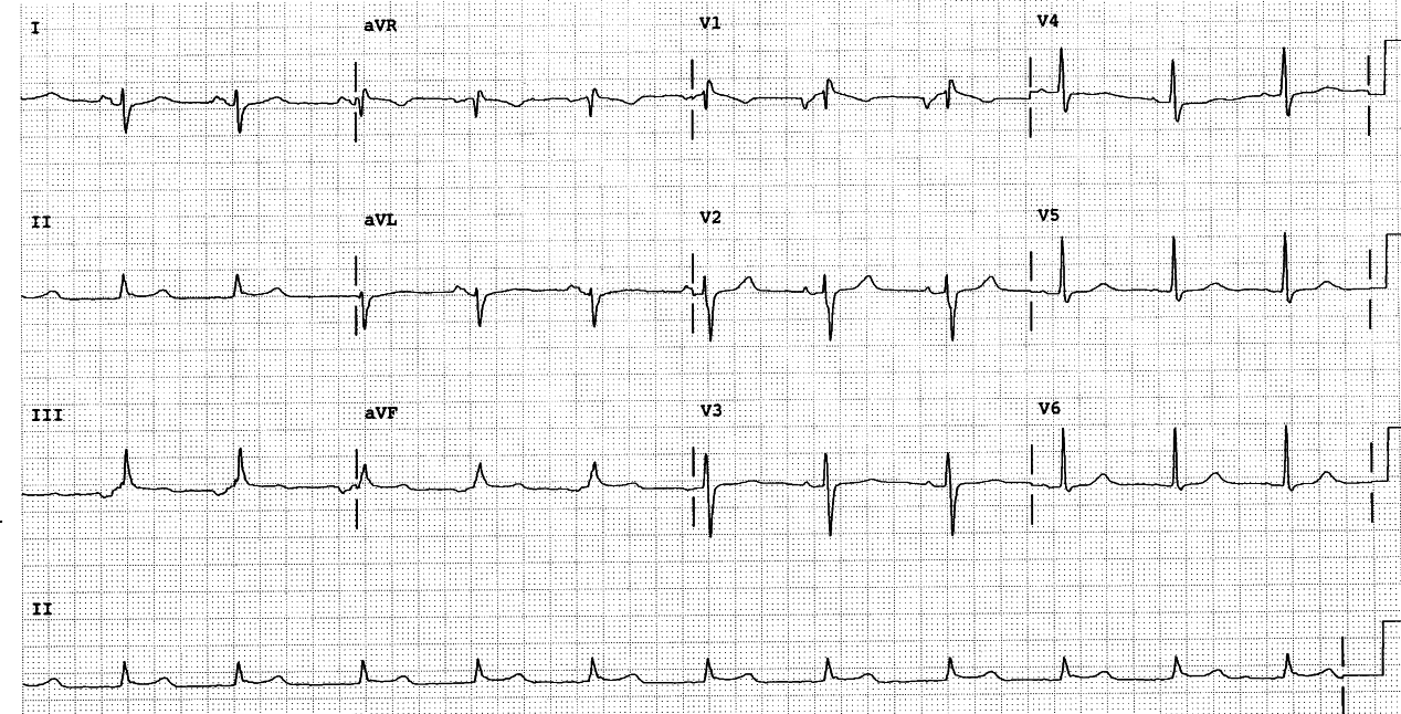 23 year old lady with intermittent atrial fibrillation