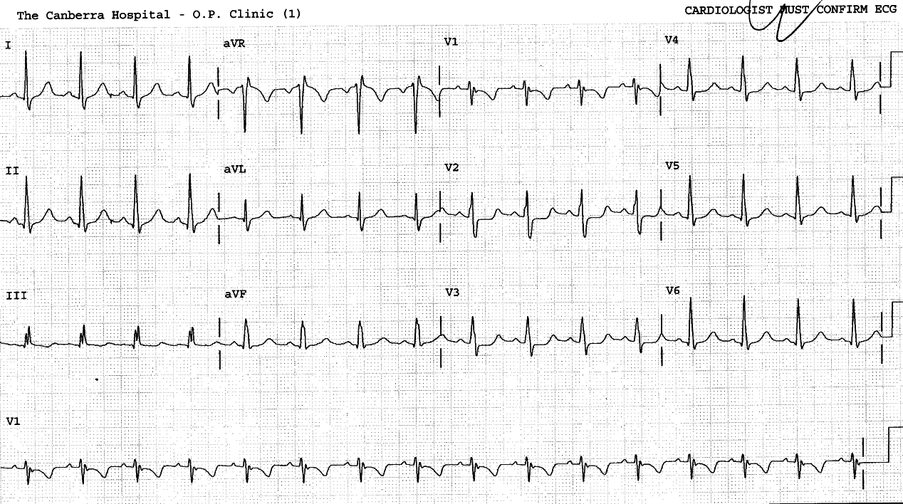 24 year old lady with progressive dyspnÅa and fatigue