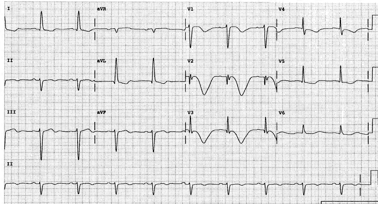 82 year old lady investigated for GI bleeding. She spent several days in CCU, where AF associated with angina and LBBB was controlled by sotalol 80 mg BD. The ECG below was taken back on Gastroenterology ward and was not reported before her discharge home. 