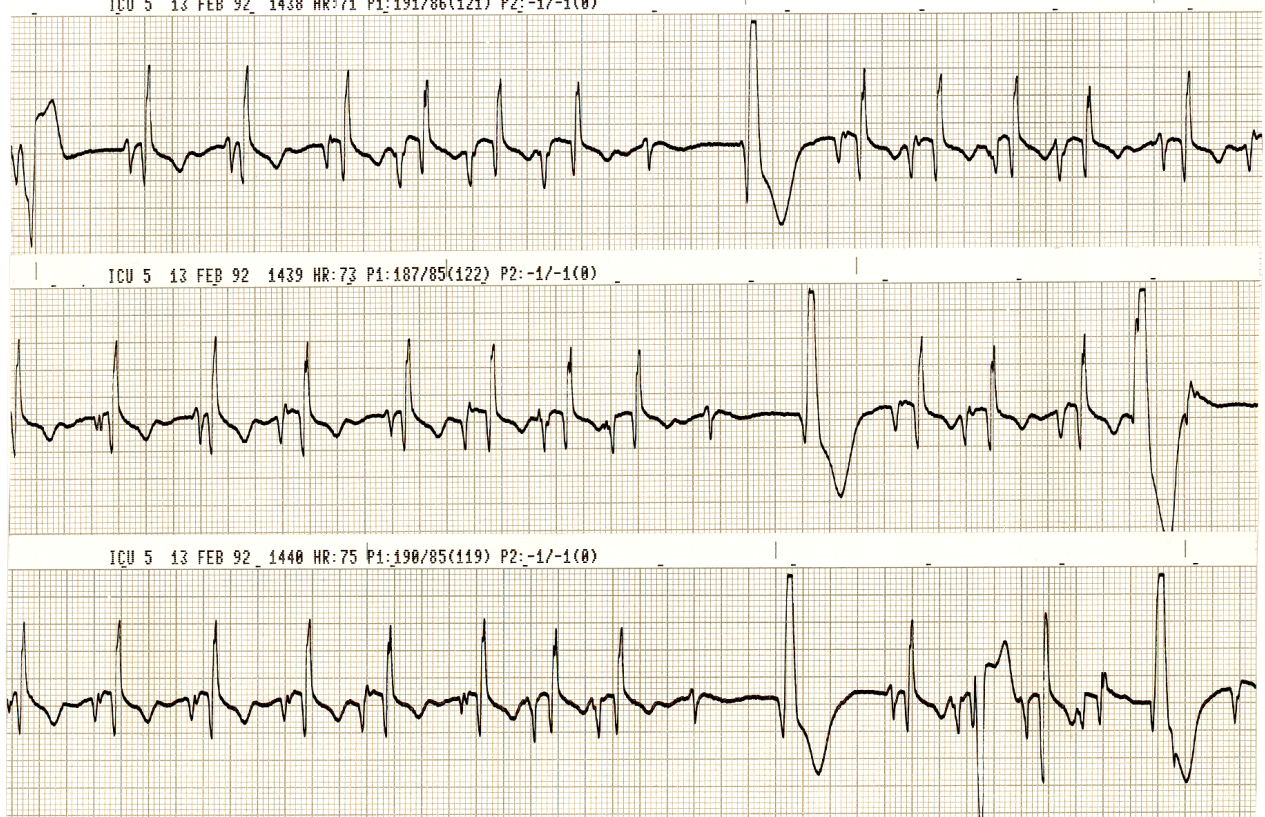 82 year old woman with an epidural abscess at C6 level. Without any apparent reason, some of her various P waves were blocked. What is the likely mechanism? 