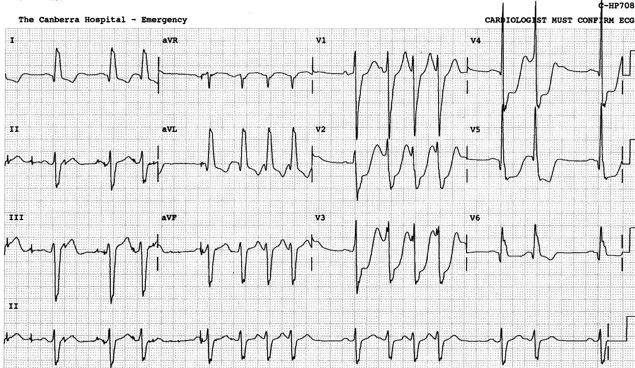 75 year old man with unstable angina and VF arrest in the Ambulance.