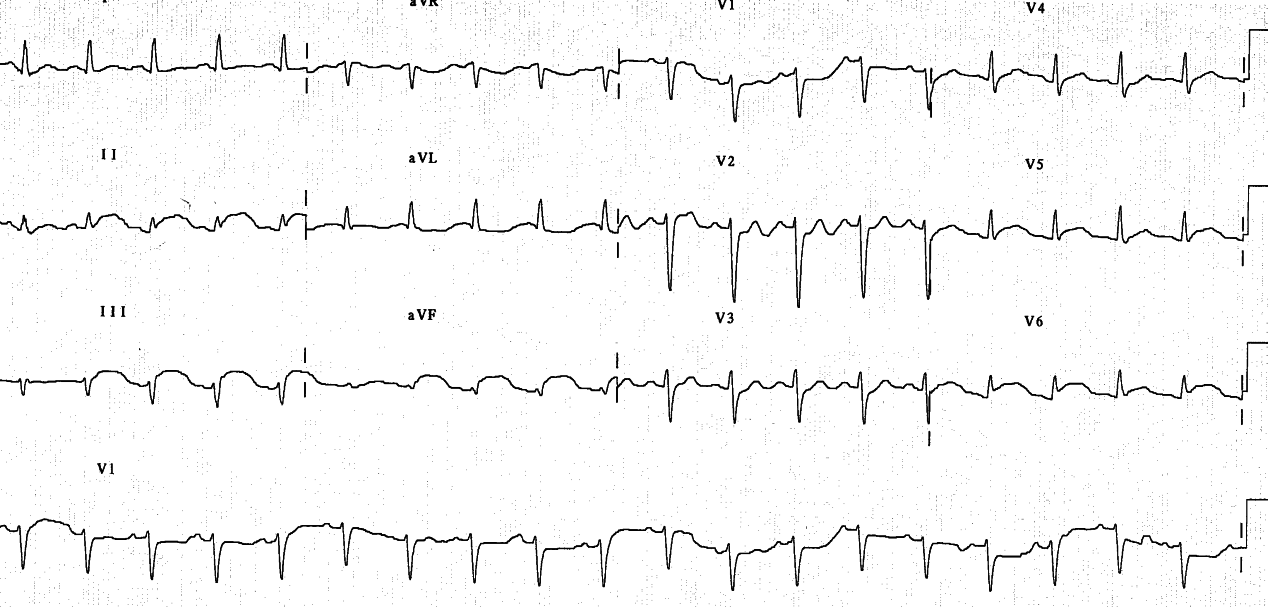 ECG an hour later.