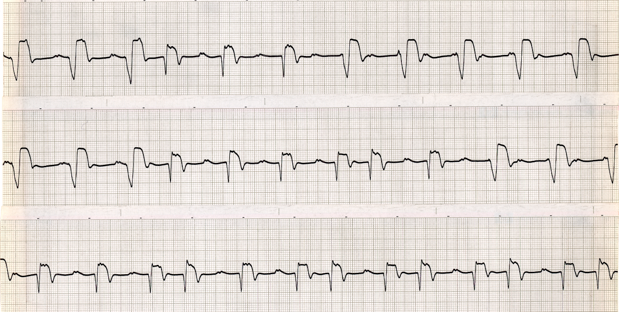 Reversion to sinus tachycardia 110/min, with variable     Wenckebach block and pacemaker escape beats and rhythm taking over when     AV block increases beyond 2:1. Top strips also, incidentally,     demonstrate the diagnostic value of narrow capture beats proving the fat     beats are of ventricular origin. Such proof is of course de       trop in this case. 