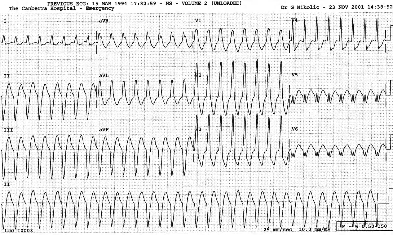 53 year old lady with symptomatic tachycardia in Casualty. 