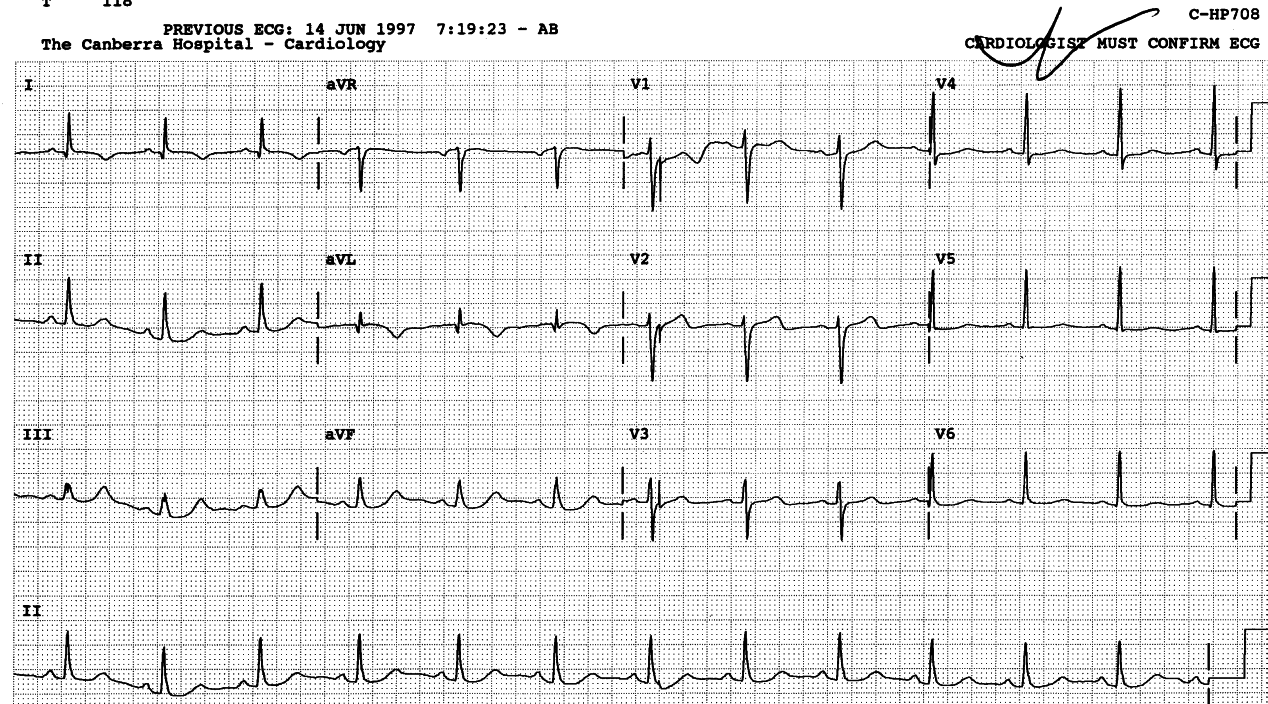 More obvious indicative changes from Fig 31 (above) and 31a (below), confined to the âhigh lateralâ leads 1 and aVL.