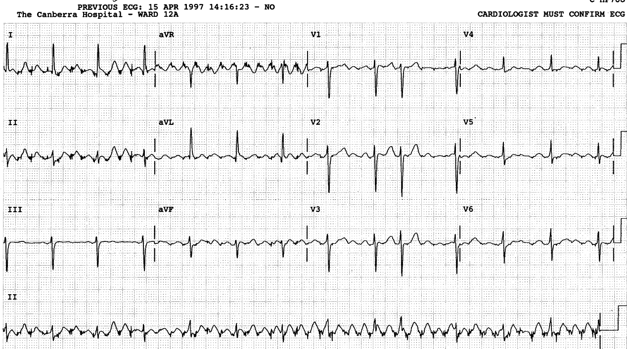 Routine ECG of an 83 year old admitted to Geriatric Ward