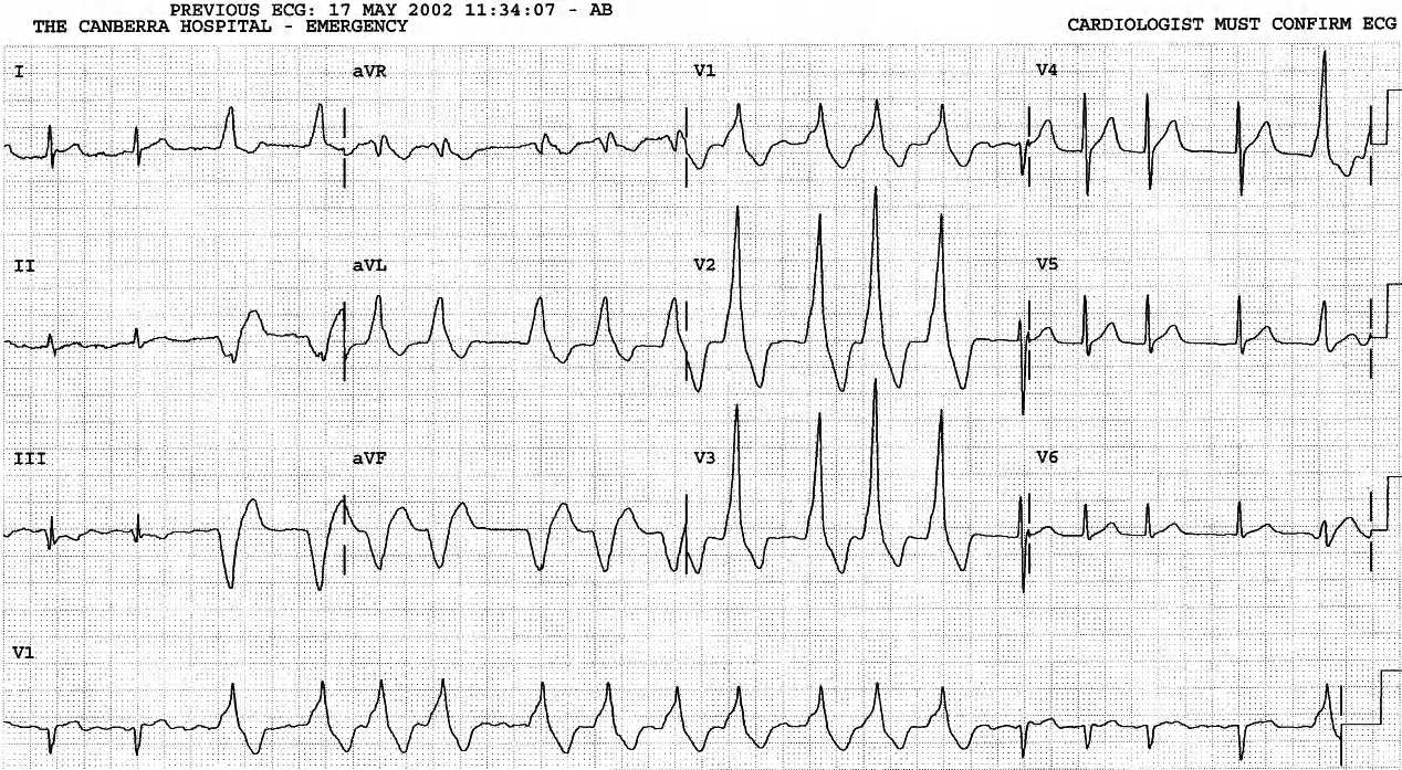 A relatively rare sight of AF with âcontrolled ventricular responseâ in WPW syndrome. 