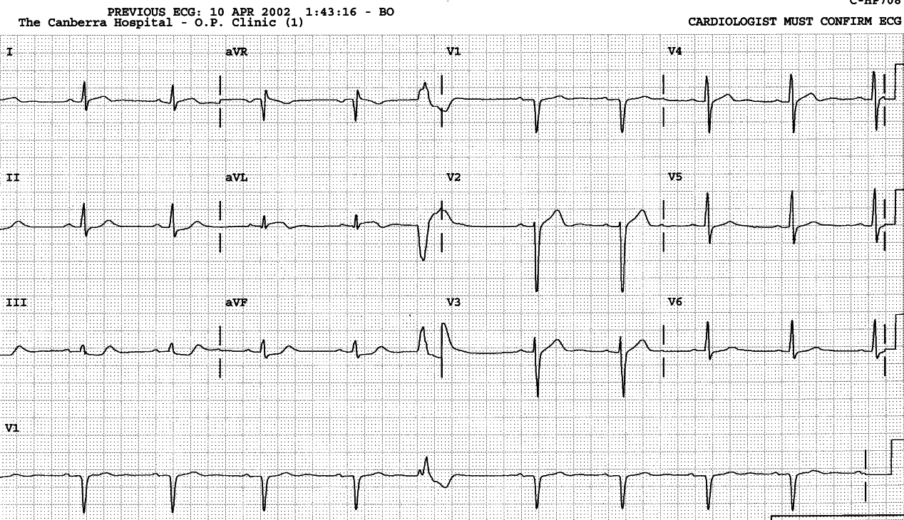 Confused and hypotensive 82 year old transferred from a nursing home.