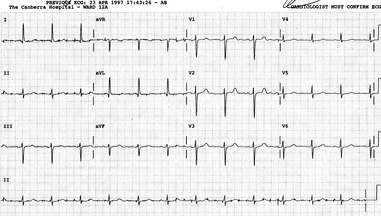 The tremor is visible as sharp little spikes; sometimes the ECG is more sensitive than clinical examination.