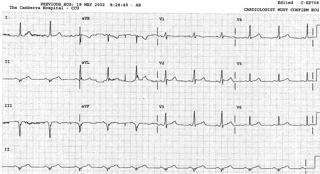 Sinus rhythm showing WPW âAâ pattern in V1. It is positively concordant albeit the delta waves are isoelectric in V5-6, making the complexes look normal there. 