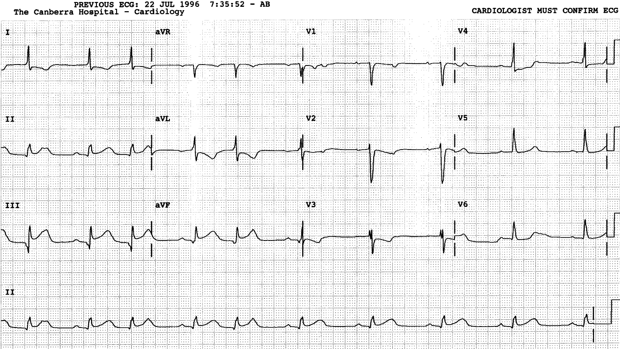 71 year old lady admitted the previous day with prolonged chest pain. 