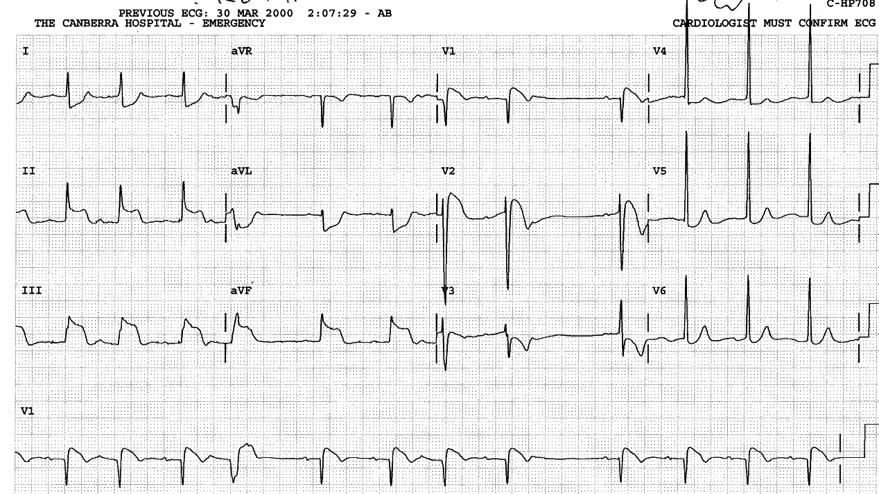 39 year old cocaine addict, distressed but incoherent in Casualty