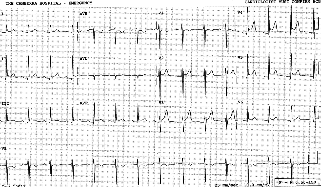 20 year old man with chest pain