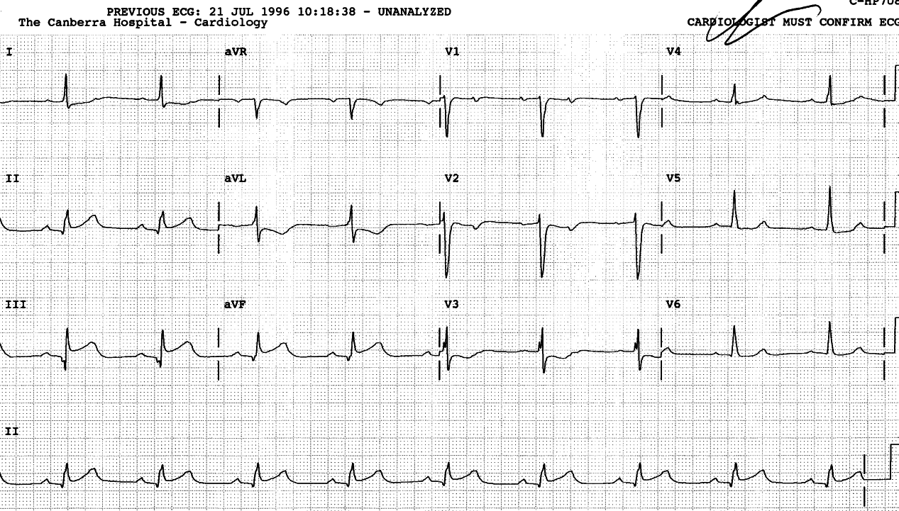 My mistake was not to look at lead V1. Always examine all the leads. 