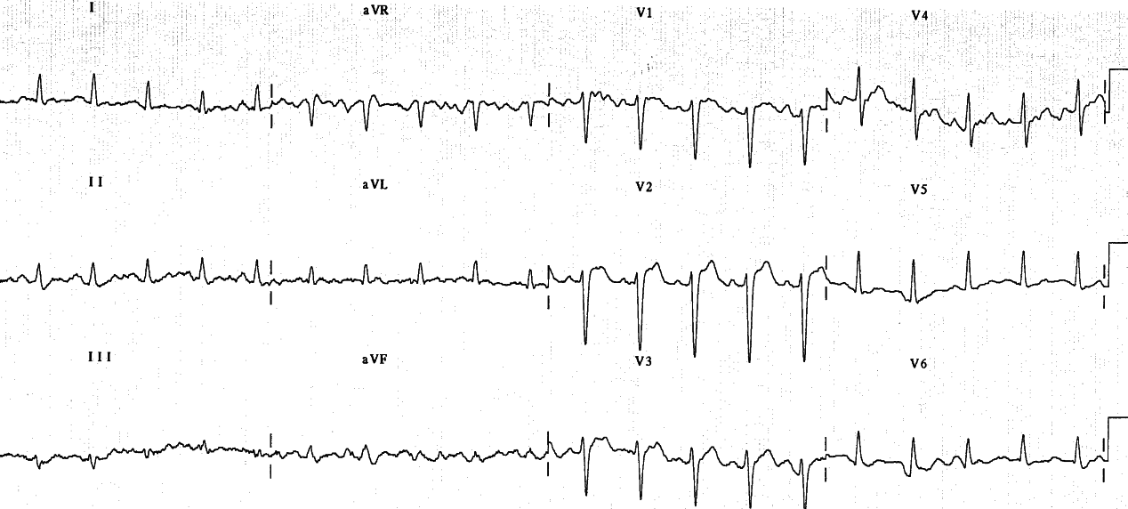 61 year old man with chronic hypertension, complaining of choking and pressure in his upper chest.