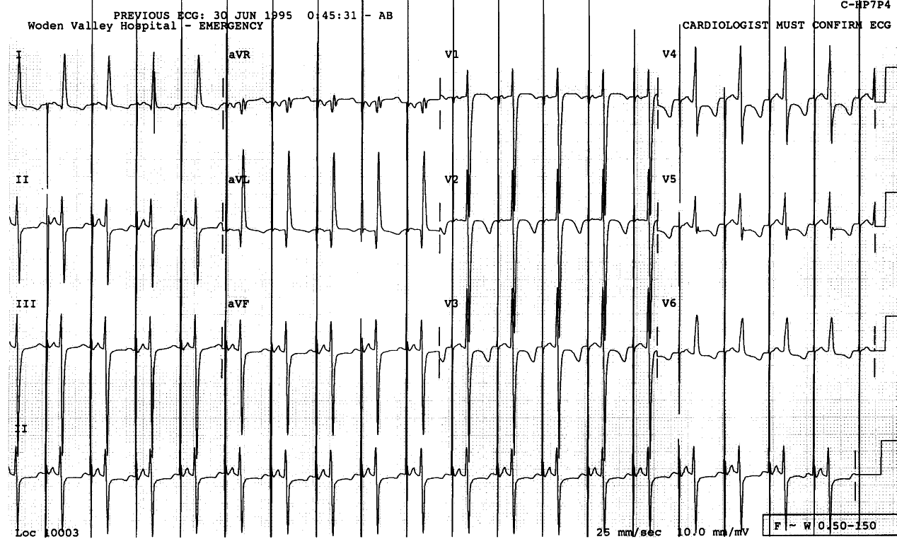 5 year old child who had Fontan repair (atriopulmonary connection) in infancy[! XE "Fontan repair" !]