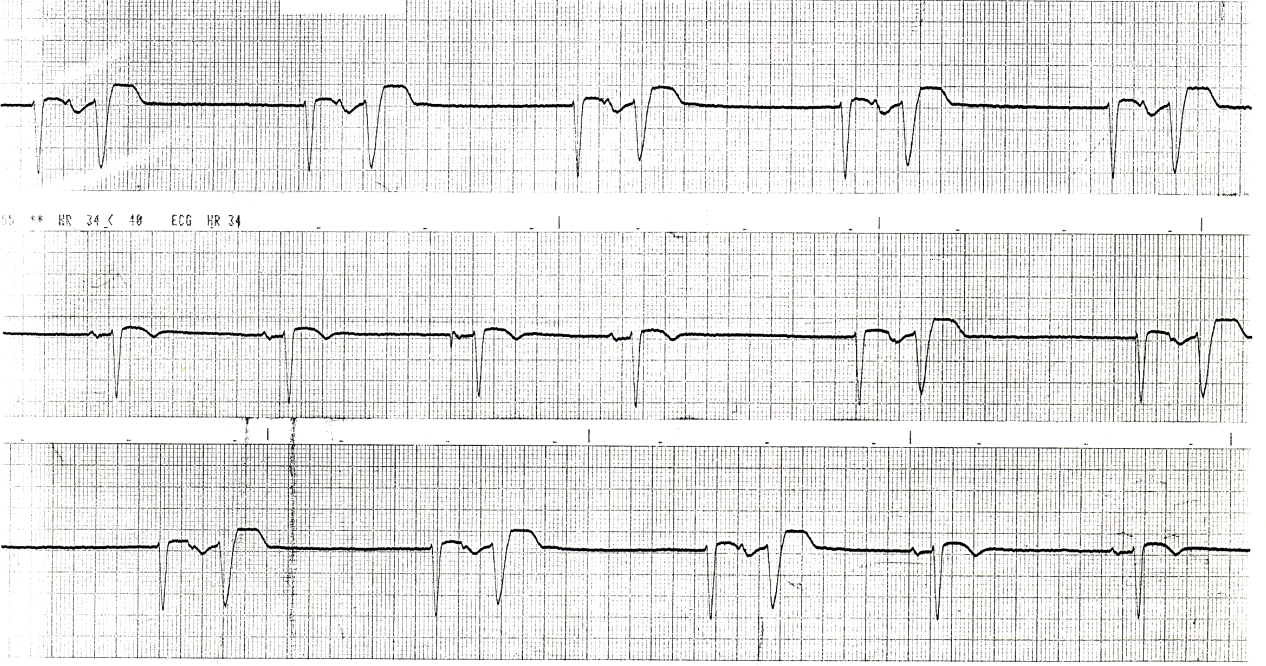 Modified lead V1 (Marriott lead). The pacemaker
is turned off. Reciprocal rhythm is caused by junctional escape
beats.