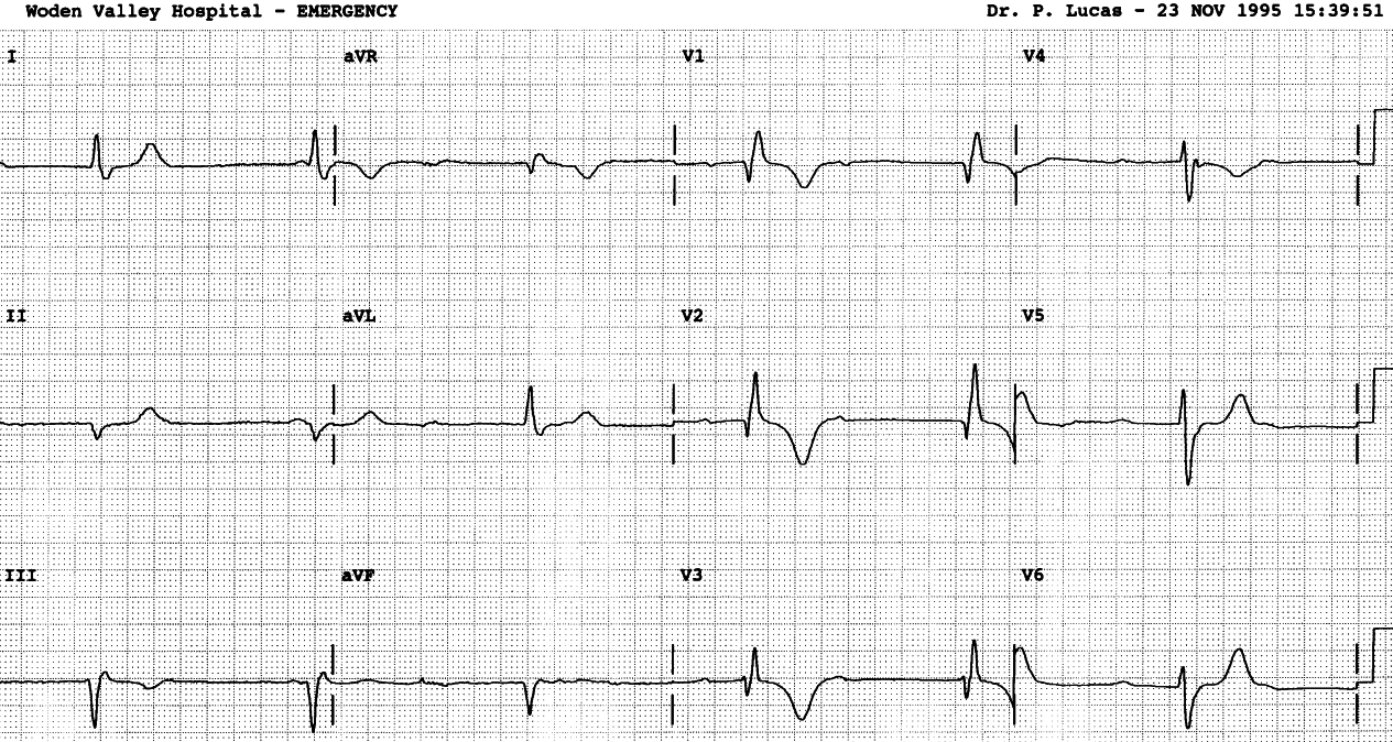 87 year old man who fainted walking down the street.     He had myocardial infarction over 30 years previously. 