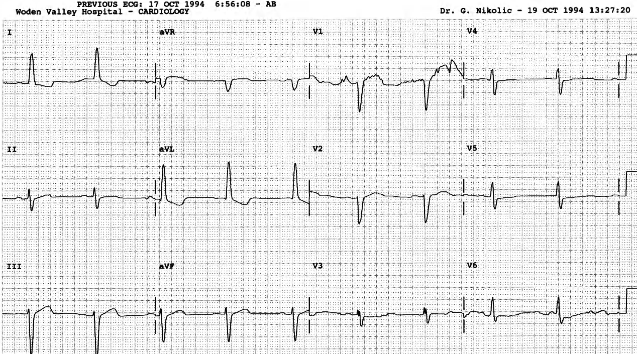 Baseline ECG. Borderline complete LBBB, probable LAA predisposing to future AF. 