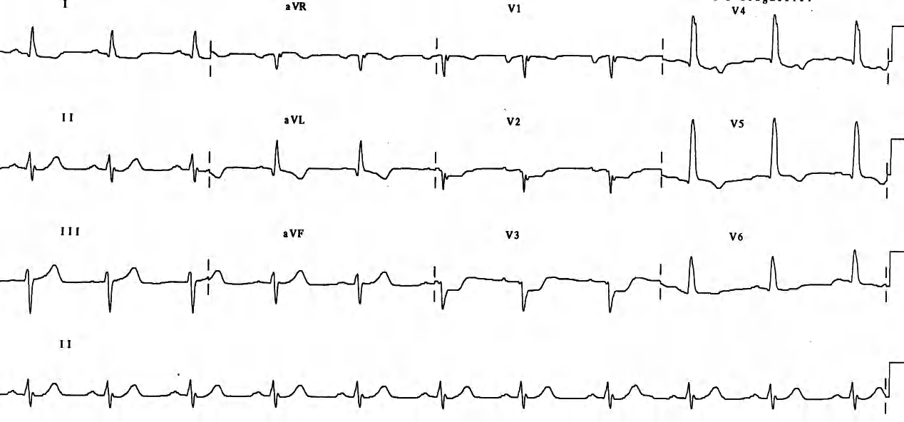 ST segment elevation is always the primary event in infarction. It is rather subtle here, in V5. 