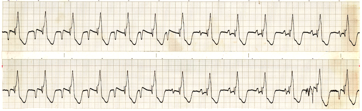 It is common knowledge that a pacemaker rhythm is     often associated with fusion beats. Where are they now? 