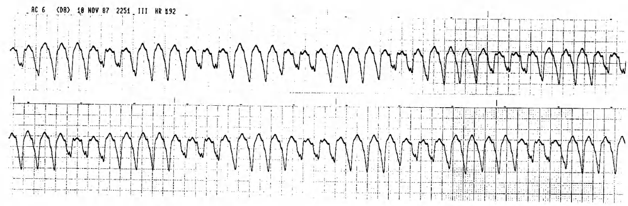 Strips obtained in ICU, prior to intubation. 