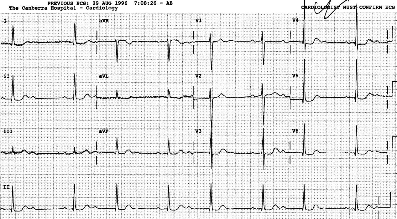 An illustration that all thatâa bigeminal isnât extrasystolic. 