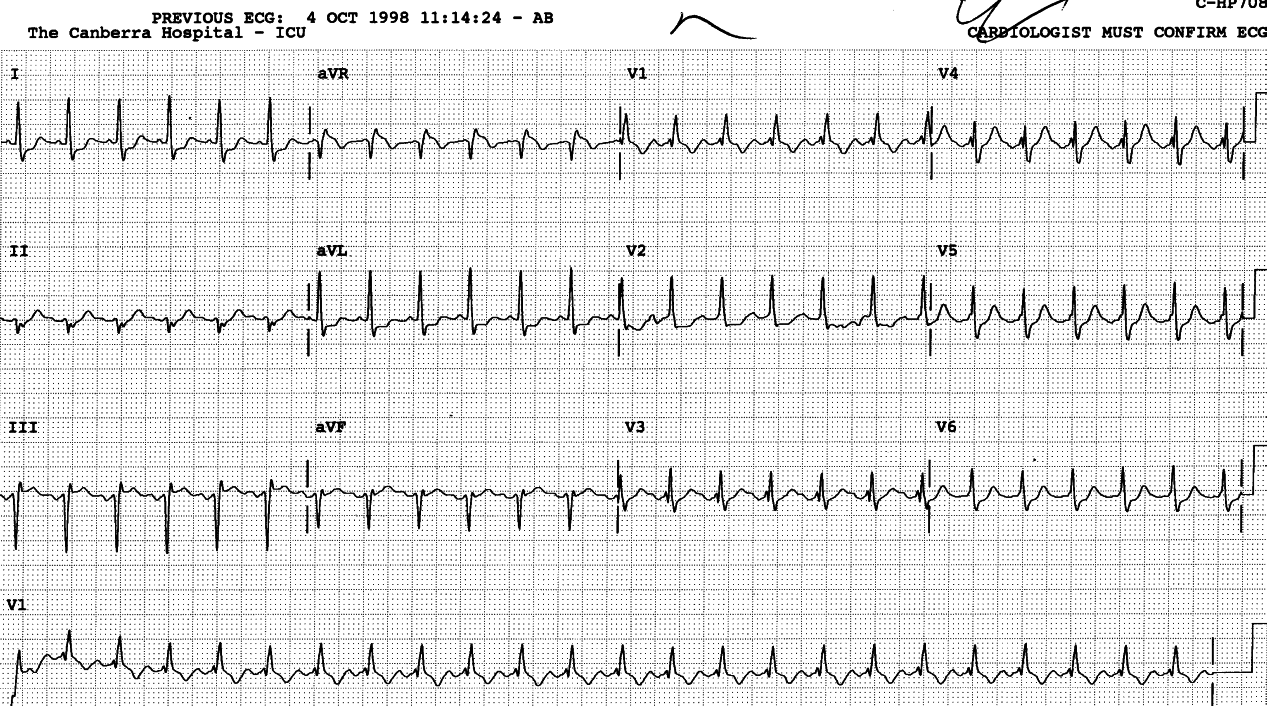 Unexpected improvement in RBBB conduction during SVT. Sometimes conductivity improves at higher speed, or else the bundle branches come to be better synchronised. I did not pretend to know the answer. The ICU staff are not very forgiving.