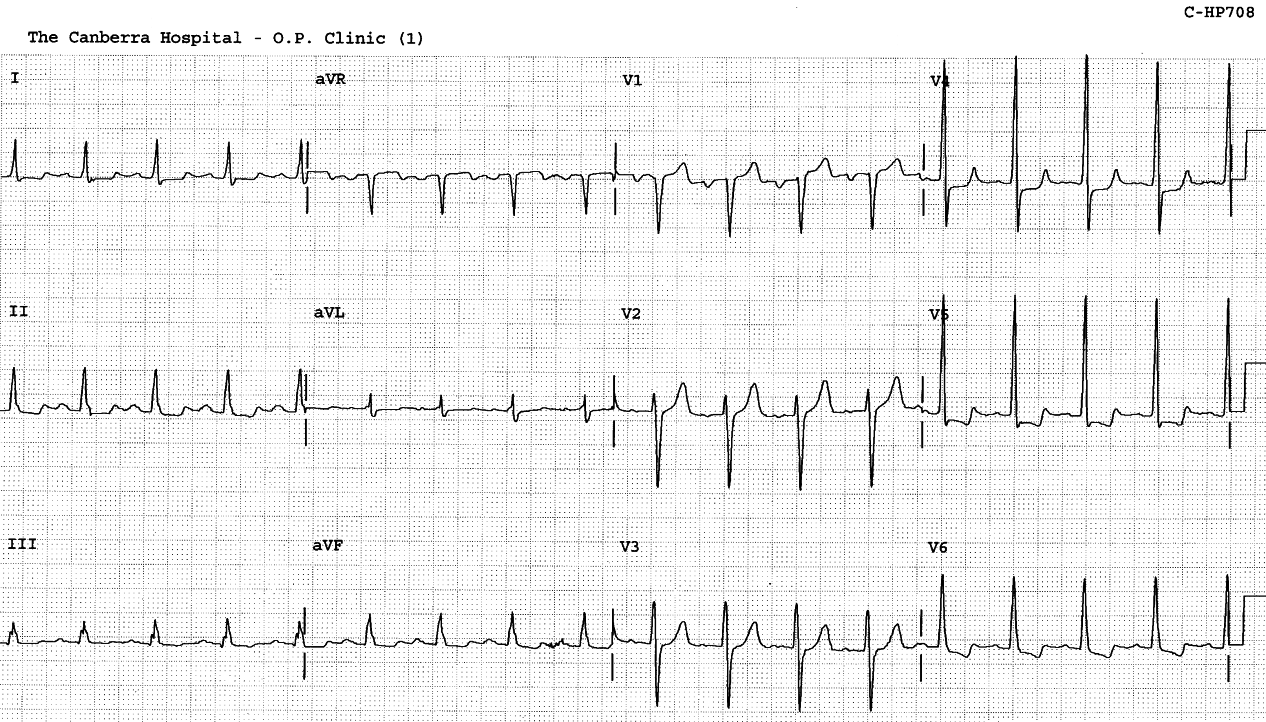 Typical LVH with ST/T changes, with supportive LAA (large PTF inV1).