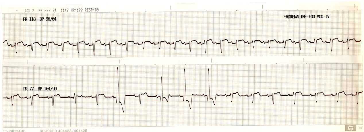 30 year old man with MOF due to ruptured bowel. The driver of the car that hit him, drunk on the road, thought it was a kangaroo. Adrenaline infusion had been running for over 6 weeks until 3 days prior to this recording. The recording shows his rate and BP response to 100 Î¼g adrenaline IV bolus. The response is unusual. What could explain it?