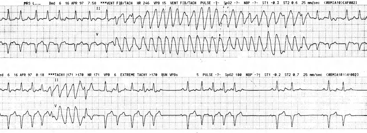 Post-arrest monitoring of a 74 year old woman with large anterior MI. 