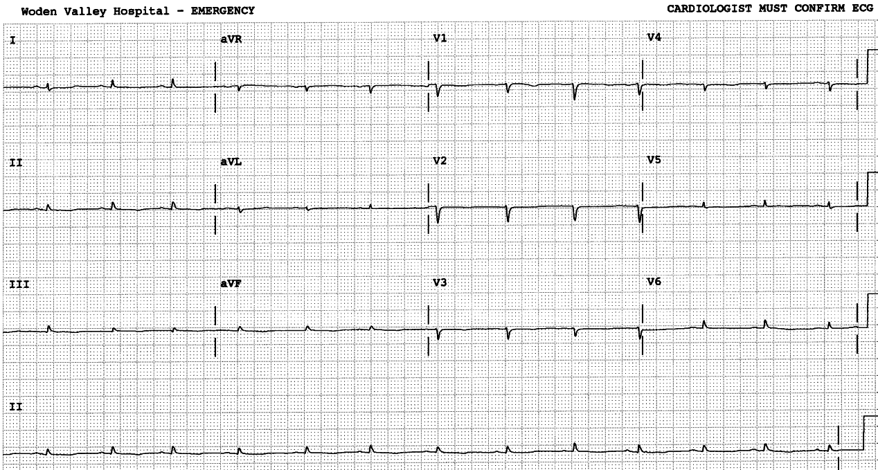 24 year old lady with DLE, presenting with dyspnÅa and fatigue. She has ascites and bilateral pleural effusions