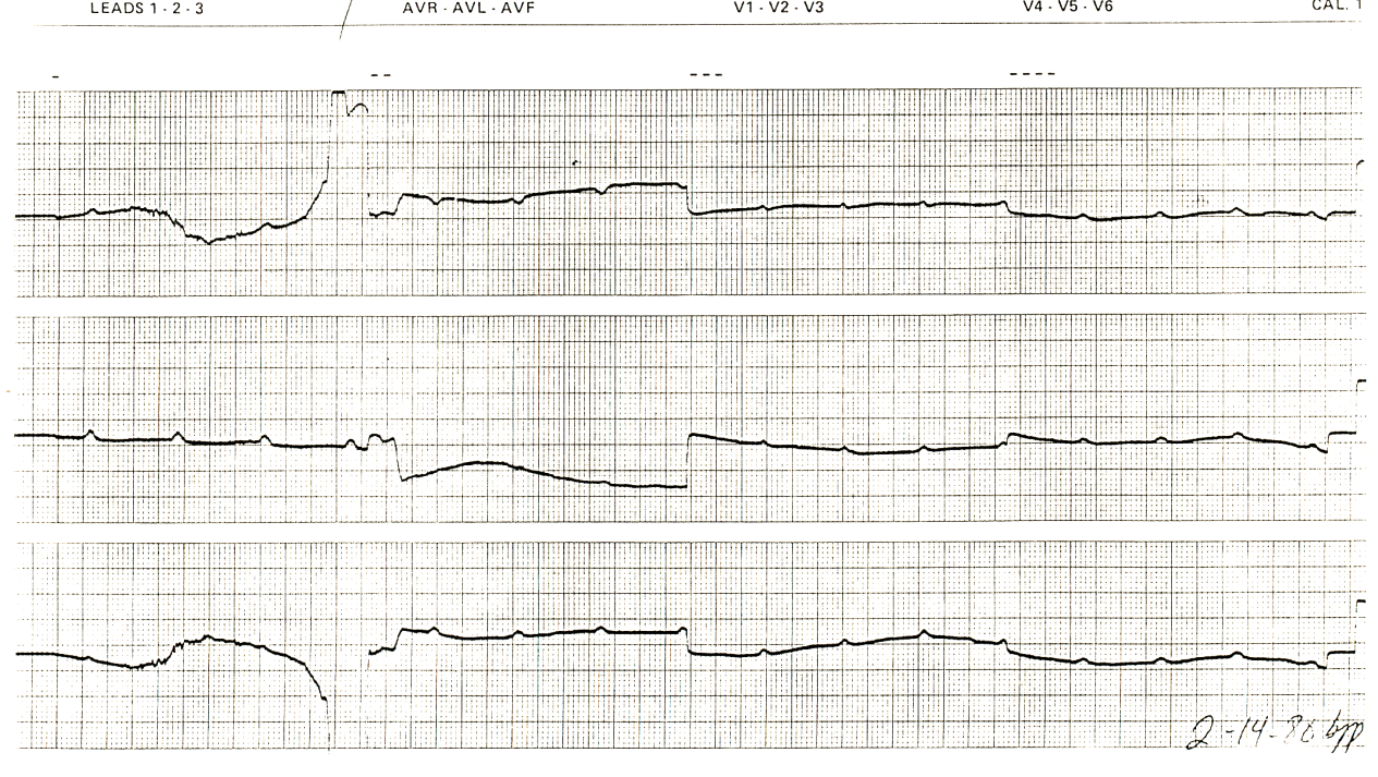 57 year old man with temporary pacemaker in the CCU. The   Cardiologist saw the ECG technician taking the trace and told her to   turn the pacemaker off, since thereâs no point reporting it. She did,   while he walked away.