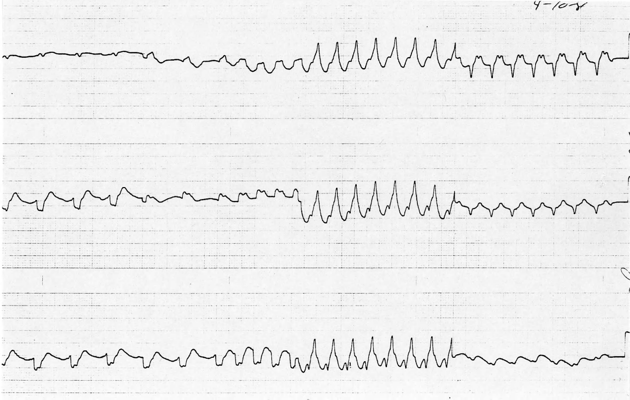 71 year old man with history of myocardial infarction 20 years previously, presenting with angina and light-headedness. 