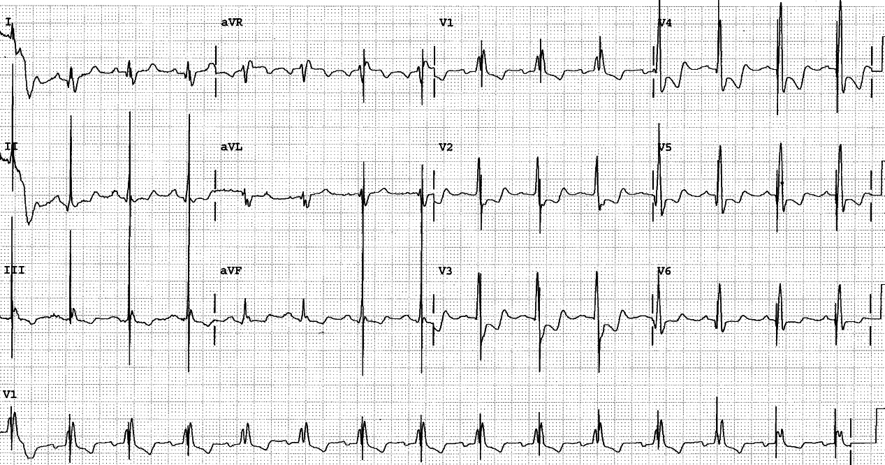 Same patient a few hours later, following the insetion of a permanent pacemaker. The sinus rhythm is conducted with RBBB distorted by pacemaker spikes (pseudofusion beats). Shorter-paced AV interval vould have resulted in haemodynamically less favourable LBBB-like ventricular pacing or true fusion sinus-pacemaker QRS complexes. [! XE "pseudofusion beats" !]