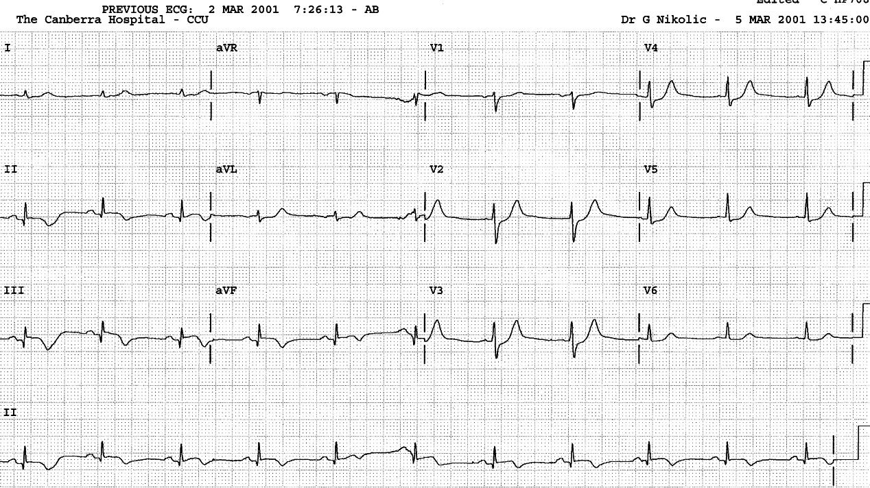 Three days later the inferior ST segment elevation is still present.