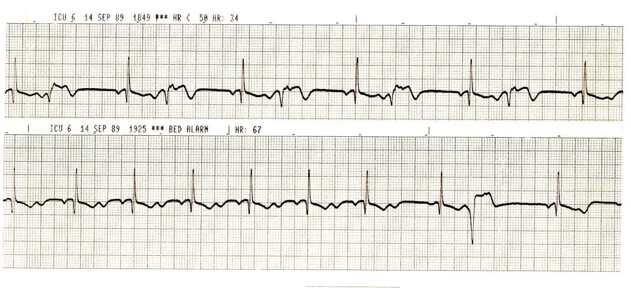 43 year old woman with pulmonary-renal syndrome due to focal crescentic glomerulonephritis, monitored during mechanical ventilation in the ICU. Current treatment included methylprednisolone, cyclophosphamide, dopamine, dobutamine, antibiotics and TPN. What else would you suggest?