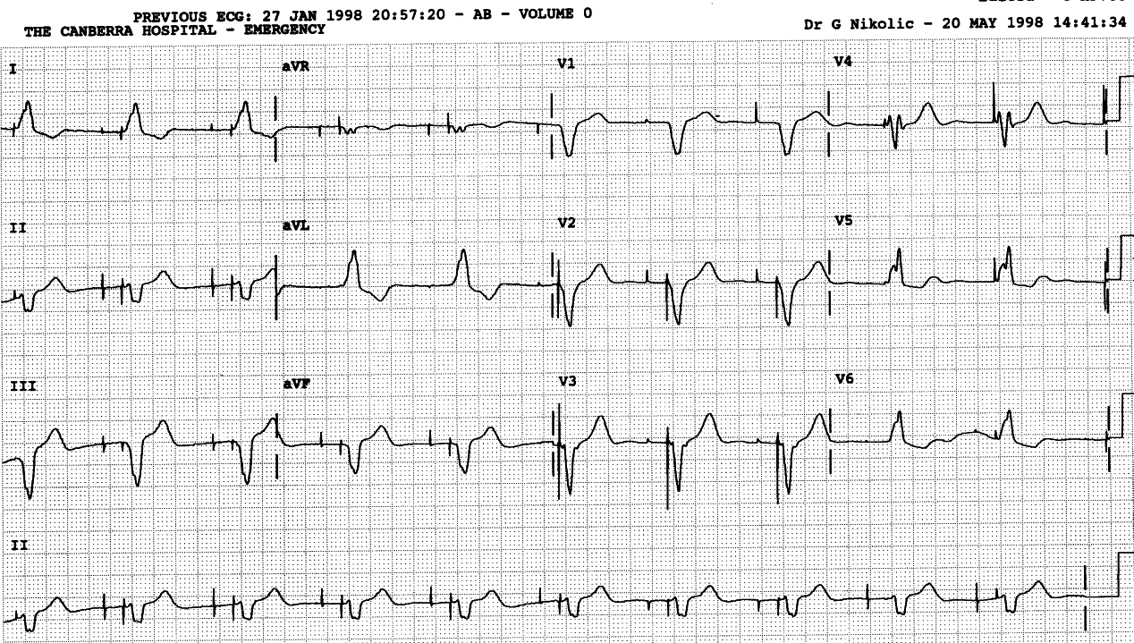 80 year old lady with episodic dizziness.